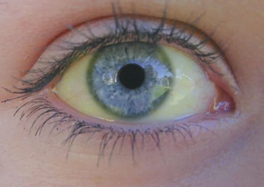 Почему глаза желтоватого. Синдром Жильбера склеры. Синдром Жильбера жёлтые белки глаз. Синдром Жильбера пожелтение склер. Желтые склеры синдром Жильбера.