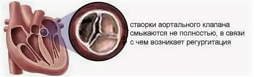 2 створчатая аорта. Аортальный клапан сердца створки. несмыкание аортального клапана. сепарация створок аортального.