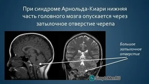 Что такое аномалия арнольда киари