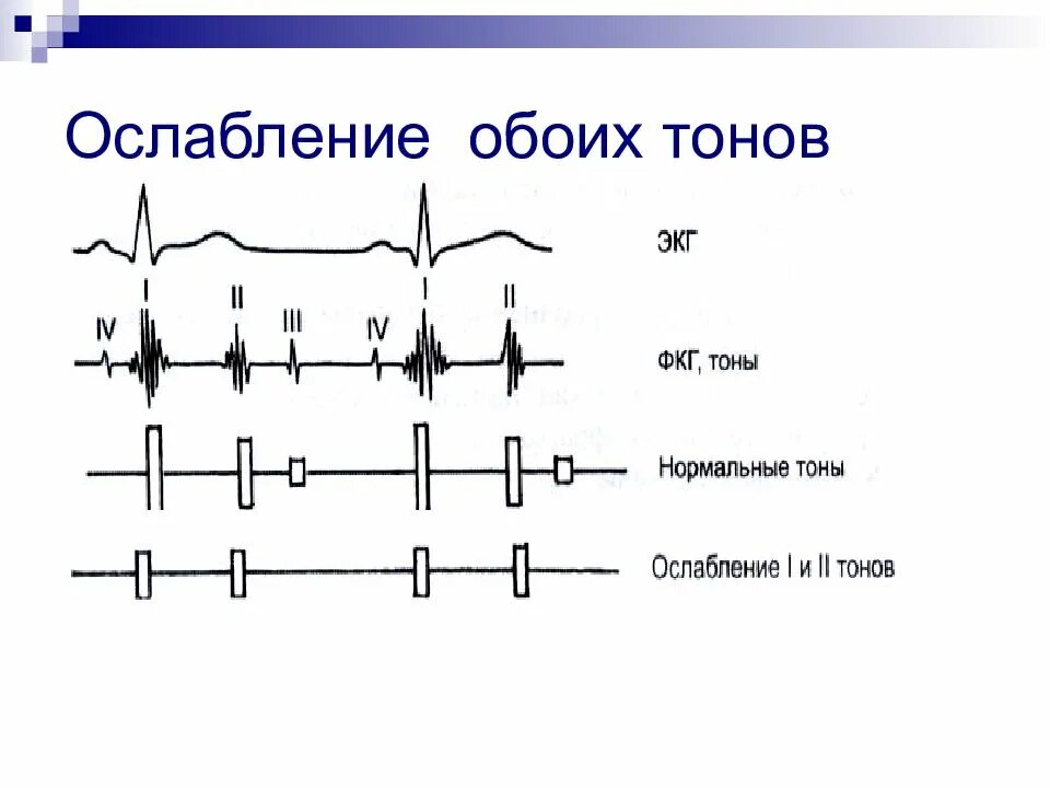 Ослабленные тоны сердца. Ослабление обоих тонов сердца. Тоны сердца ослаблены. Тоны сердца аускультация. Тоны сердца в норме и патологии.