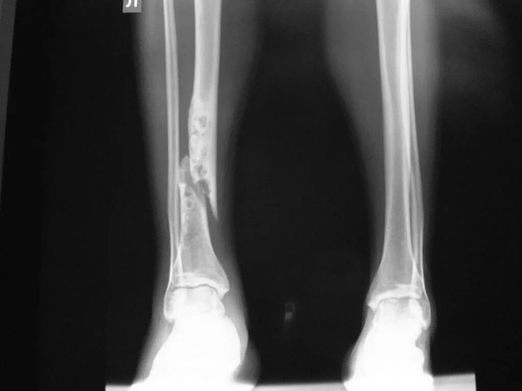 Перелом большеберцовой кости. Берцовая кость открытый перелом. Осколочный перелом голени. Поперечный перелом голени рентген.