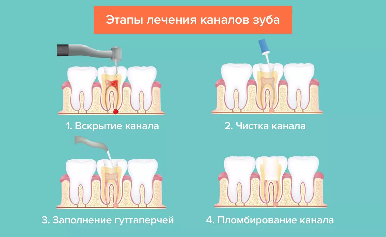 Этапы лечения кариеса зубов таблица. Корневые каналы зубов схема. Кариес пульпит периодонтит схема. Этапы лечения кариеса зубов поэтапно. Этапы эндодонтического лечения