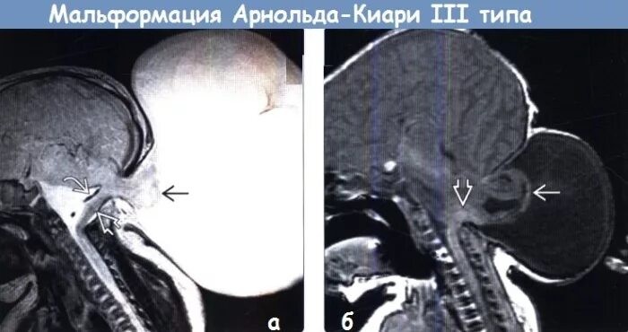 Аномалия арнольда киари что это простыми. Гидроцефалия Арнольда Киари 2. Аномалия Арнольда Киари 1 типа мрт головного мозга. Мальформация Киари 1 типа.