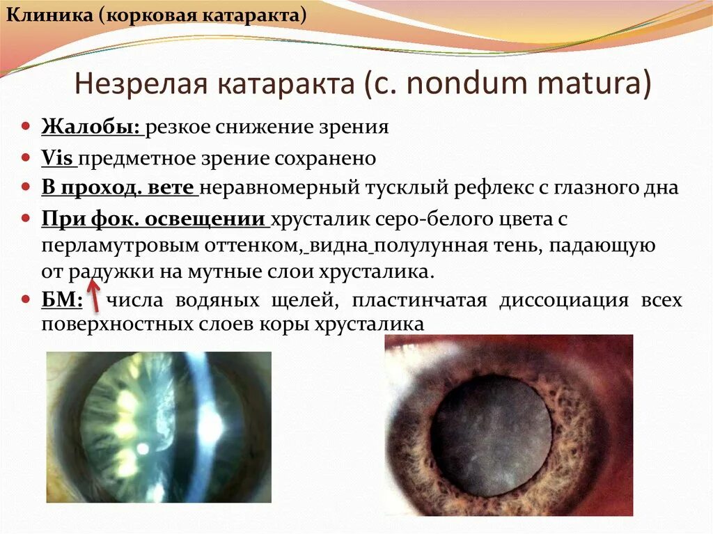 Начальная корковая катаракта. Корковая катаракта стадии. Незрелая стадия возрастной катаракты. Незрелая корковая катаракта. Начальная старческая катаракта