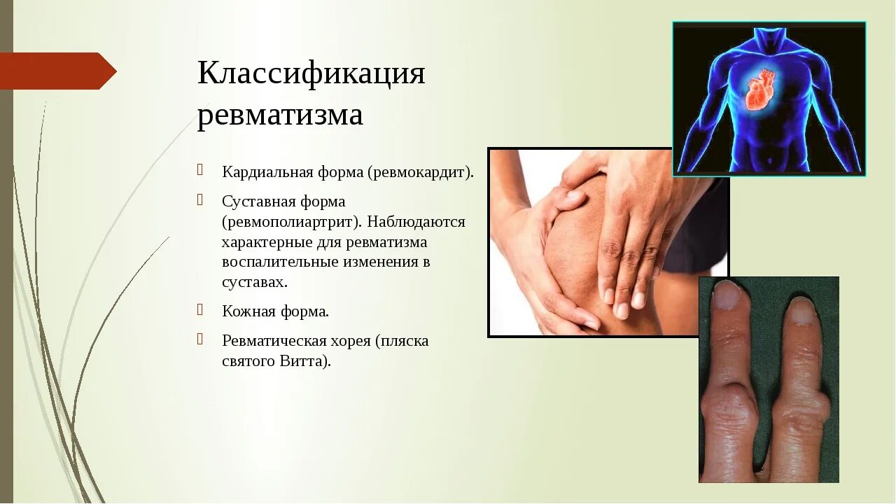 Какие симптомы ревматизма и лечение. Поражение суставов при ревматизме. ревматизм с поражением суставов симптомы. ревматизм у детей симптомы этиология. суставной форма ревматизма симптомы.