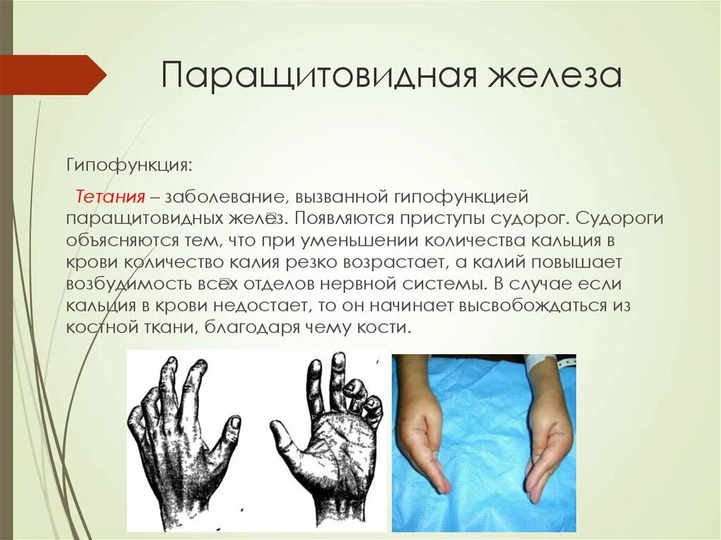 Гипофункция паращитовидных желез вызывает. Гипофункция паращитовидной железы. болезни паращитовидной железы. гипофункция околощитовидных желез. паращитовидная железа гипофункция и гиперфункция.