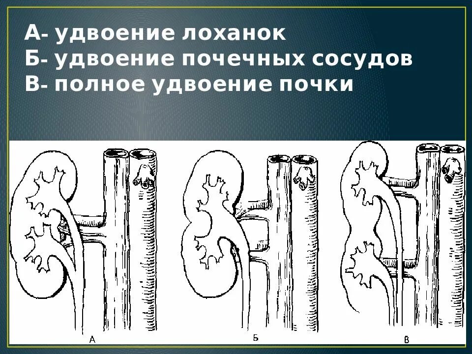 Удвоение почечной вены. Удвоение почечной лоханки. Полное удвоение почки.