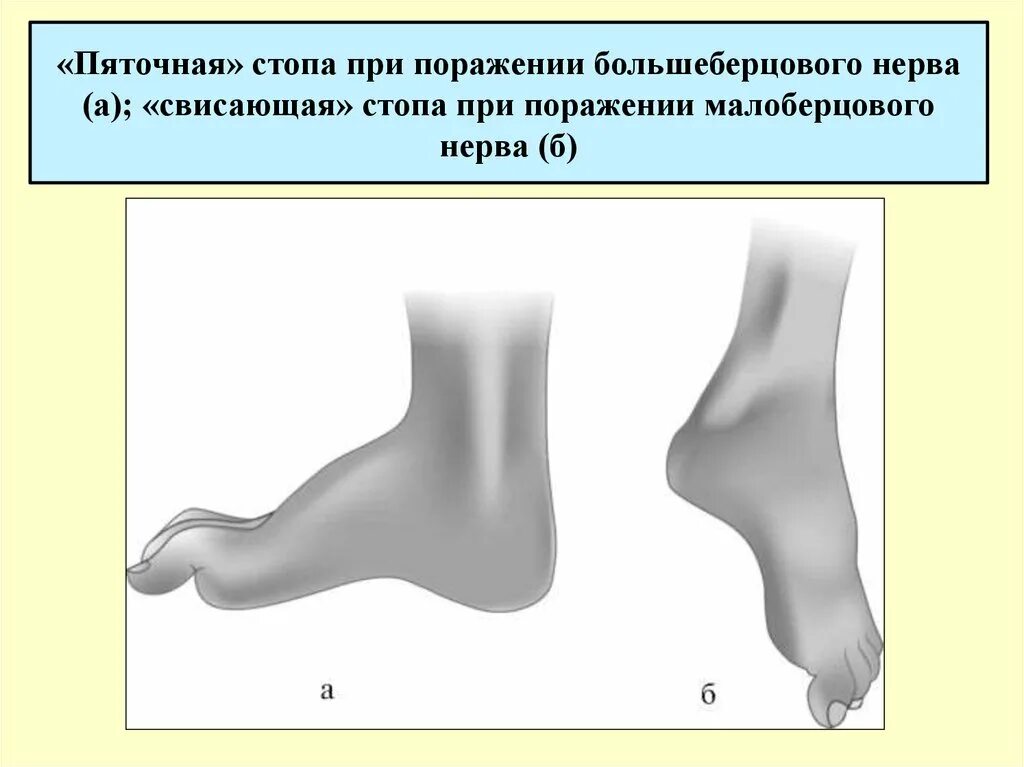 Невропатия стопы. Повреждение поверхностного малоберцового нерва. Невропатия большеберцового нерва. Невропатия малоберцового и большеберцового нерва. Поражение большеберцового и малоберцового нерва.