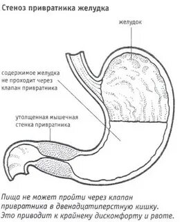 Как лечить привратника