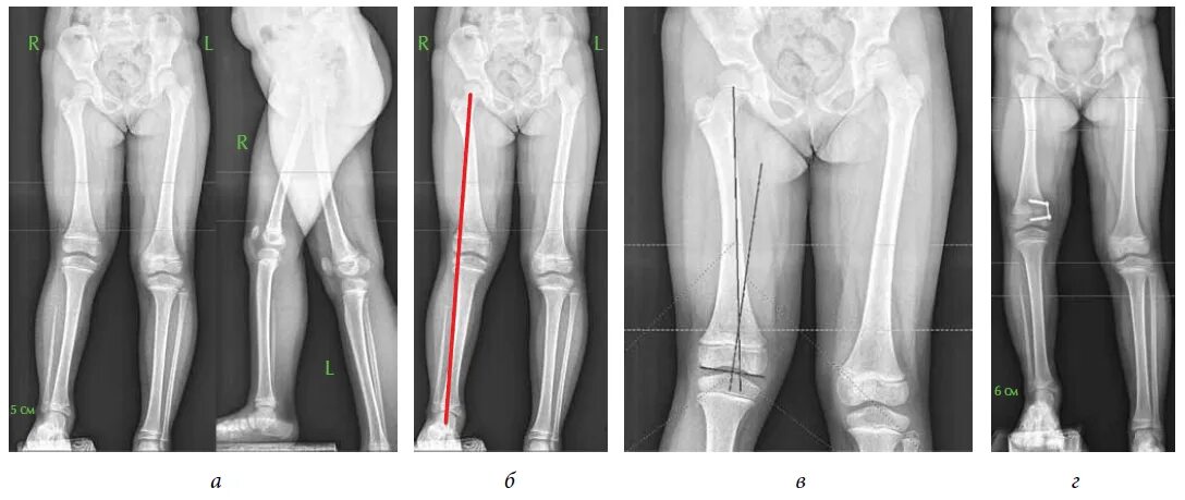 Рентген телеметрия нижних конечностей. Рентген костей голеней у детей. Варусная деформация коленных суставов рентген. Рентгеновская топограмма нижних конечностей.