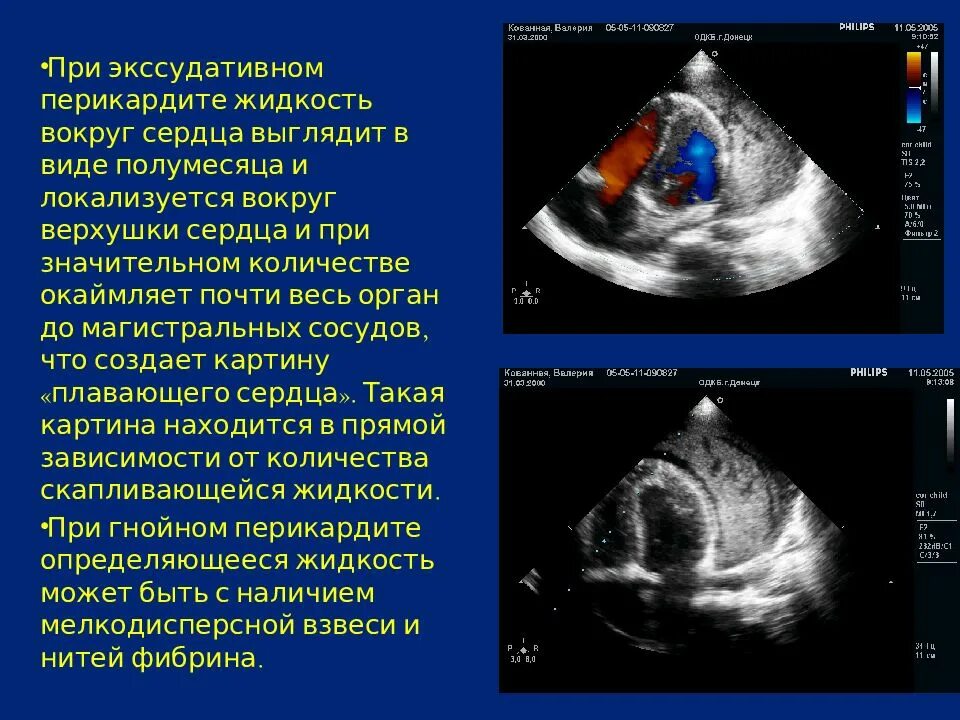 Скопление воздуха и крови в перикарде. Эксудативный прерикардит эхокардиогра. Экссудативный перикардит ЭХОКГ. Острый фибринозный перикардит ЭХОКГ. Эхокардиография сердца перикардит.