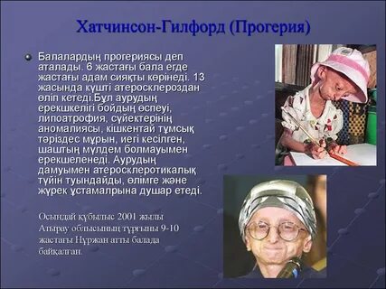 Синдром гилфорд