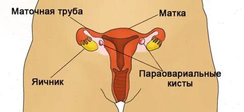 Почему растут яичники