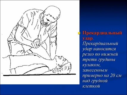 Нанесение прекардиального удара в область грудины