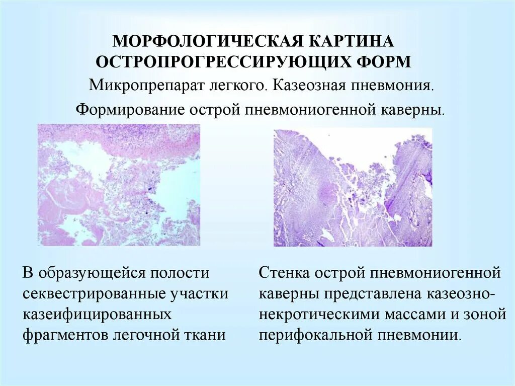 Казеозная пневмония препарат патанатомия. Казеозная пневмония при туберкулезе микропрепарат. Казеозная пневмония патанатомия микропрепарат. Казеозная пневмония описание микропрепарата. Морфологическая дезинтеграция