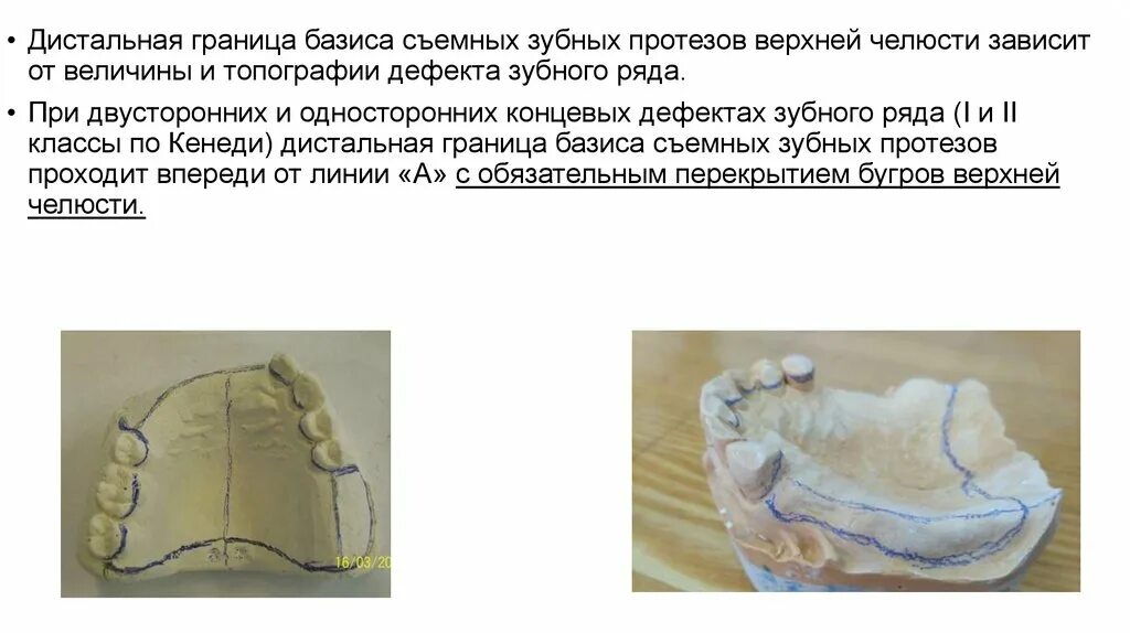 Линия базиса. Границы базиса ЧСПП на верхней челюсти. Границы базиса протеза на верхней челюсти. Граница базиса протеза на нижней челюсти. Границы частичного съемного протеза.