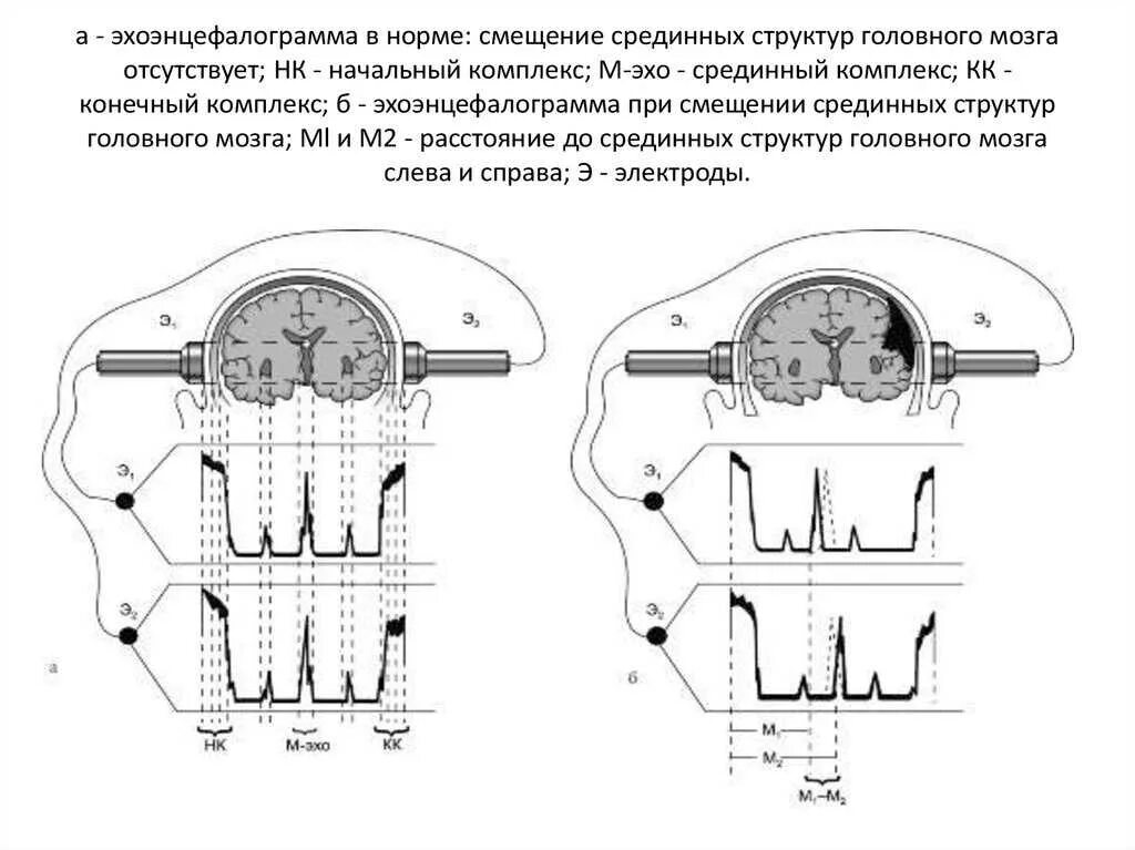 Эхоэнцефалоскопия расшифровка результатов. Эхоэнцефалоскопия при ЧМТ. Эхо ЭГ показатели нормы. Смещение структур головного мозга. Эг что это за обследование