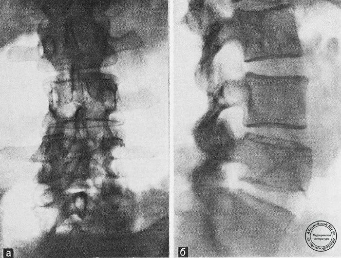 Патологический перелом тела. Патологический перелом тела th5 позвонка. Компрессионный перелом тела l4. Патологический перелом тела. Патологический перелом на фоне остеопороза.