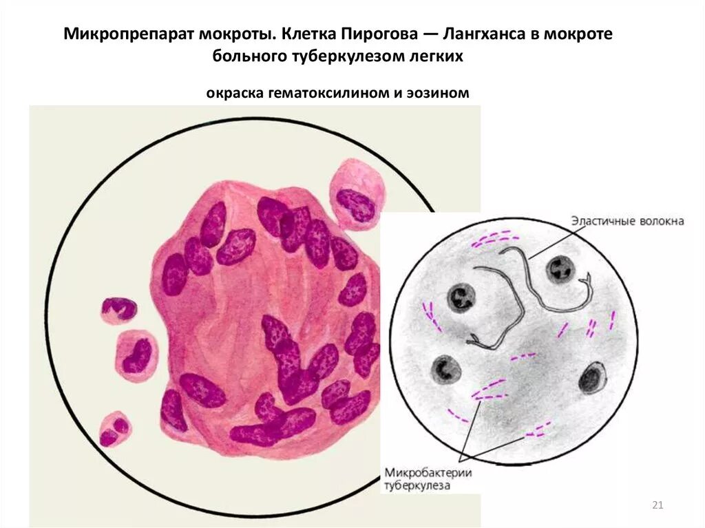 Реакция мокроты. Клетки Пирогова Лангханса гистология. Клетки Пирогова Лангханса в мокроте. Клетки Пирогова Лангханса туберкулез. Микроскопия мокроты при туберкулезе.