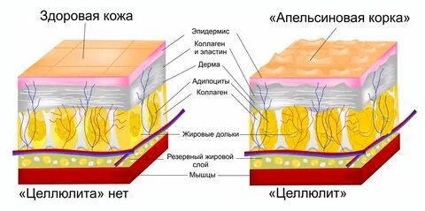 Воспаление клетчатки кожи