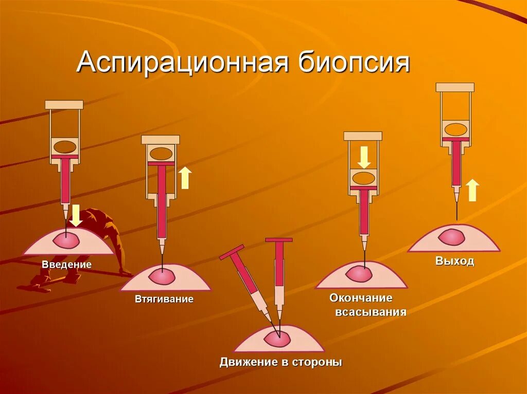 Биопсия полости матки. Аспирационная биопсия. Аспирационная биопис я. Аспирационная биопсия эндометрия. Аспирационная пайпель биопсия.