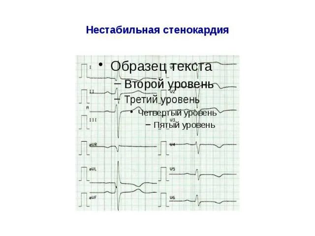 Нестабильная стенокардия карта вызова. Нестабильная стенокардия ЭКГ. Нестабильная стенокардия клиника. ЭКГ при нестабильной стенокардии. ЭКГ при нестабильной стенокардии описание.