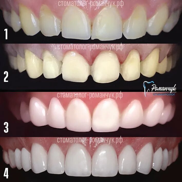 Композитные виниры без обточки зубов. Виниры стачивание зубовато. Виниры люминиры ультраниры компониры. Обтачивание зубов ло винир. Виниры люминиры ультраниры.