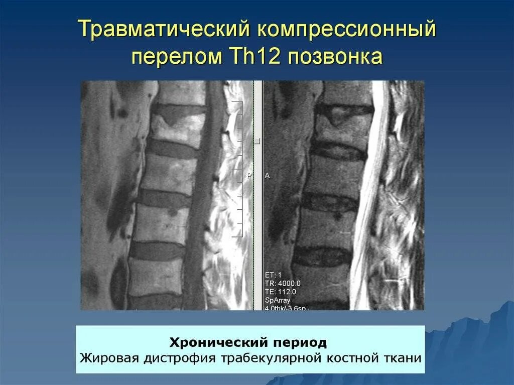 Компрессионный перелом позвонков l3 l4. Компрессионный перелом позвоночника th12 l1. Компрессионный перелом позвоночника 12го позвонка грудного отдела. Компрессионный перелом th12 позвонка.