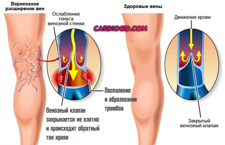 Застой вен. Флебит вен нижних конечностей. варикозное расширение вен нижних конечностей проявляется. варикозное расширение вен нижних конечностей тромбофлебит. постинъекционный флебит.