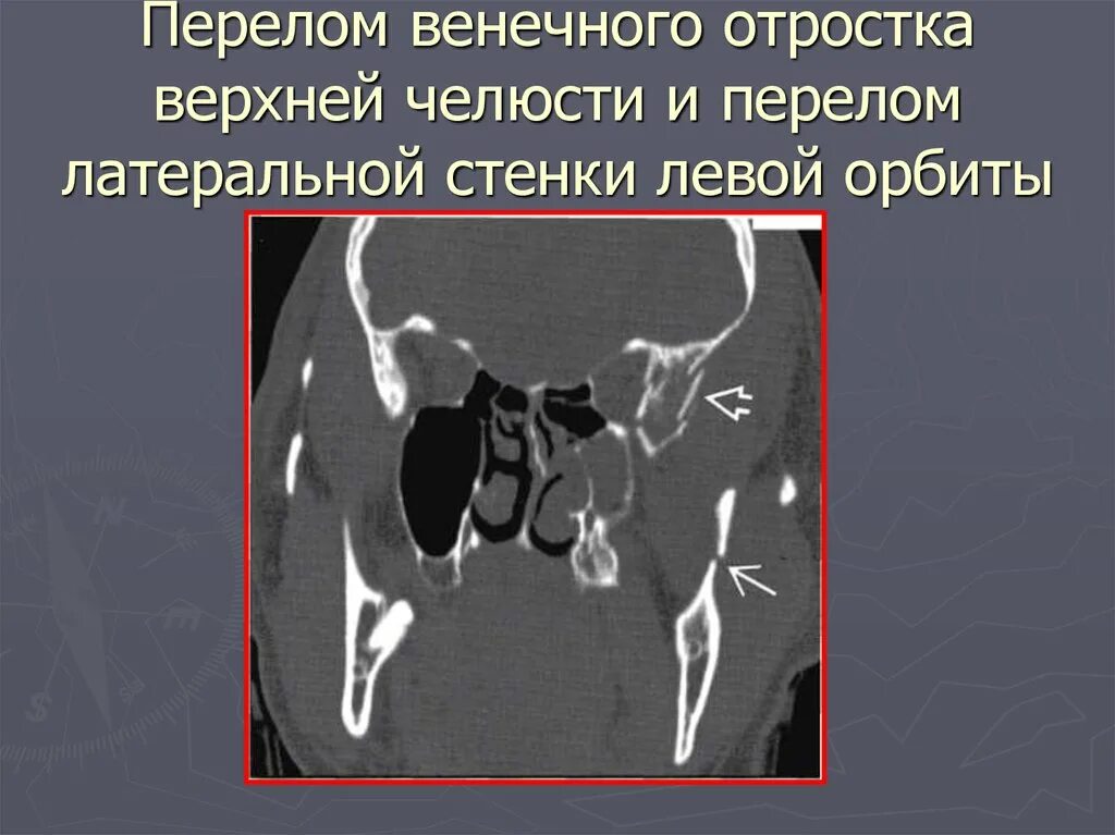 Перелом стенки левой орбиты. Перелом верхней челюсти кт. перелом нижней челюсти на кт. перелом венечного отростка челюсти. переломы нижней челюсти на к т.