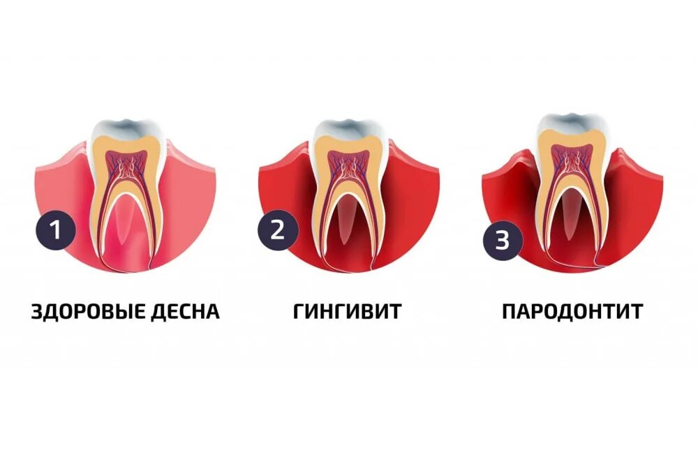 Воспаление зубов и десен.