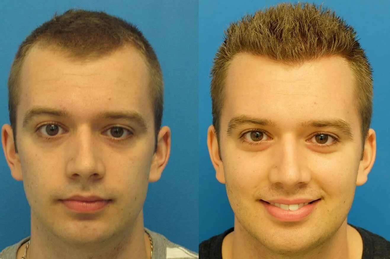 Виды вирусных гепатитов. Антитела к коронавирусу график. Через какое время можно выявить. Антигены вич. Инкубационный период вич.