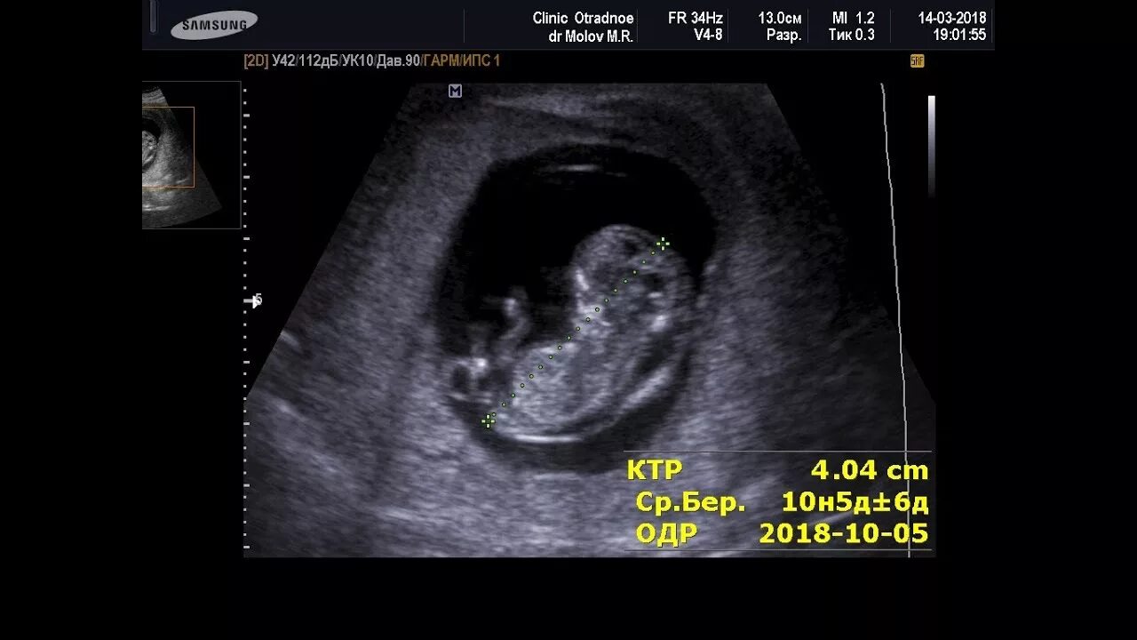 12 неделя беременности 2 беременность. УЗИ 12 недель ТВП. ТВП 10 недель беременности. Ультразвуковое исследование скрининг беременности 12 недель. УЗИ эмбриона 12 недель беременности ТВП.