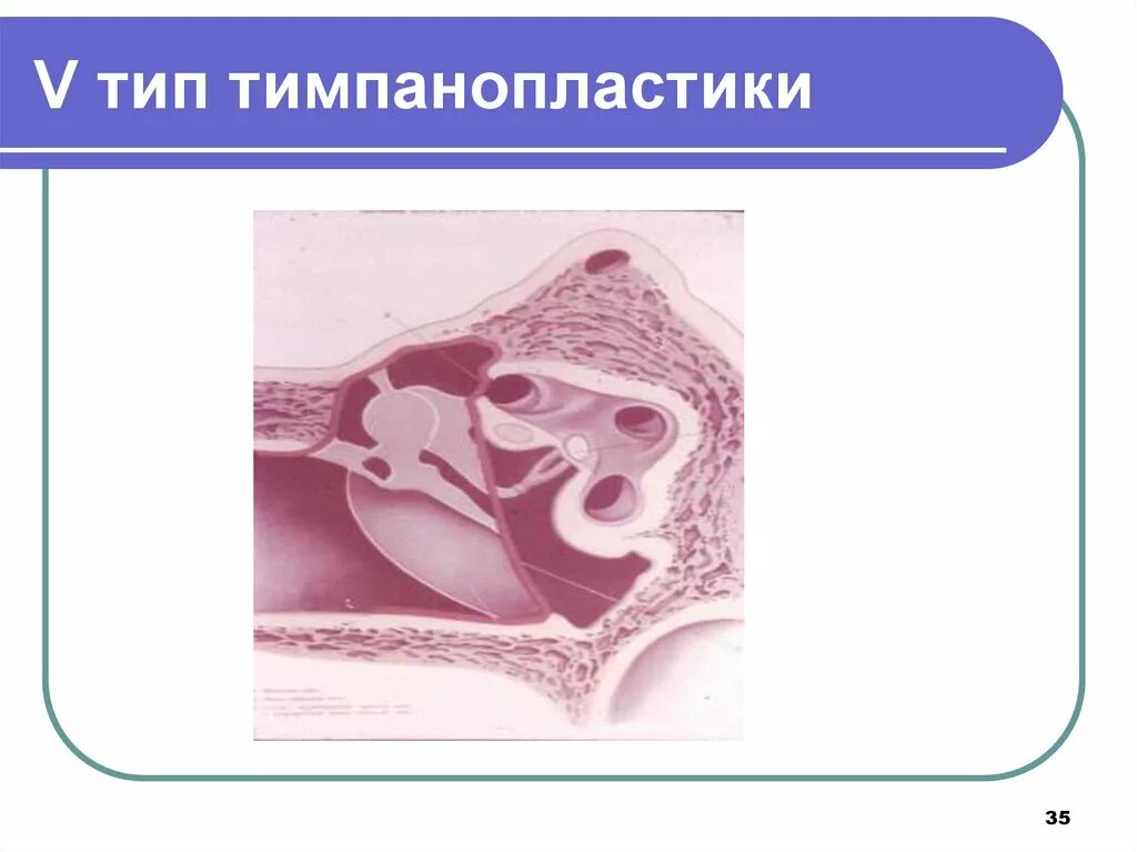 Тимпанопластика отзывы. Тимпанопластика классификация. Типы тимпанопластики по Вульштейну. Тимпанопластика типы и методы.