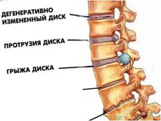 После операции на позвоночнике дают инвалидность. Грыжа позвоночника. Грыжа поясничного отдела. Операции на позвоночнике поясничного отдела. Грыжа позвонка.