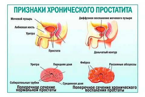 Удаление простаты у мужчин последствия отзывы