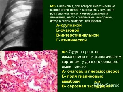Фиброз легких причина лечение