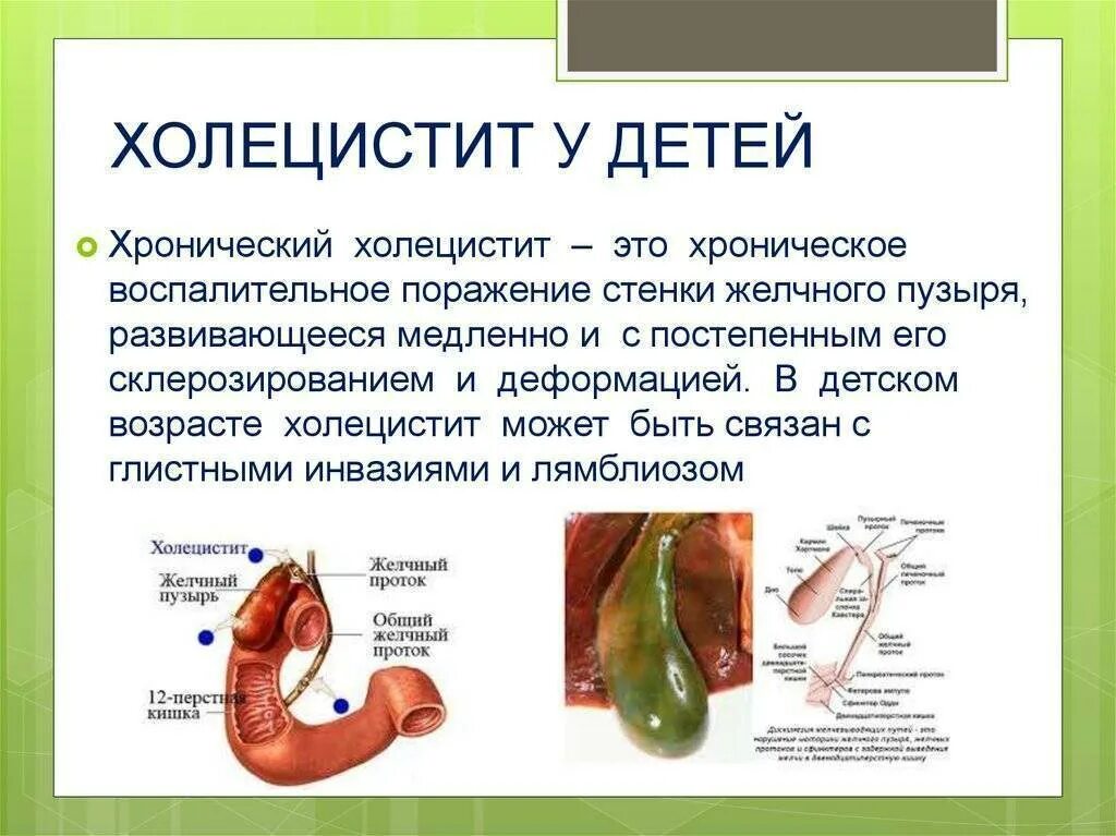 Холецистит желчного пузыря лечение. Синдромы желчного пузыря симптомы. симптомы поражения желчного пузыря. хронический холецистит и дискинезия желчевыводящих путей. жёлчный пузырь симптомы заболевания.