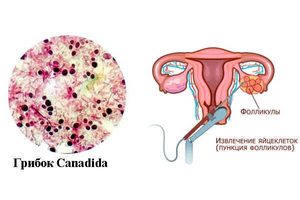 Боли после пункции фолликулов. Эко пункция яйцеклеток. Пункция фолликулов яичников.