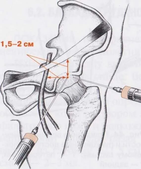Блокада техника выполнения. Пункция тазобедренного сустава техника. Техника пункции и тазобедренного сустава сустава. Методика пункции тазобедренного сустава. Пункции суставов плечевой сустав.
