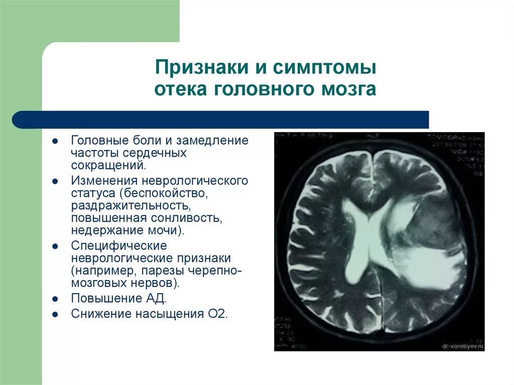 Отек мозга 3. Отек головного мозга симптомы. Причины опухоли головного мозга. Объемное образование головного мозга у ребенка. Отек головного мозга причины.