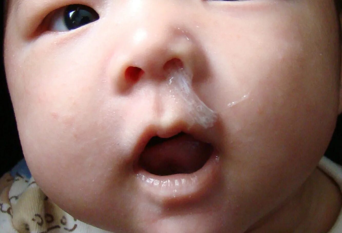 Нос течет ручьем. Сифилитический ринит у новорожденных. Слизистые сопли у новорожденного.