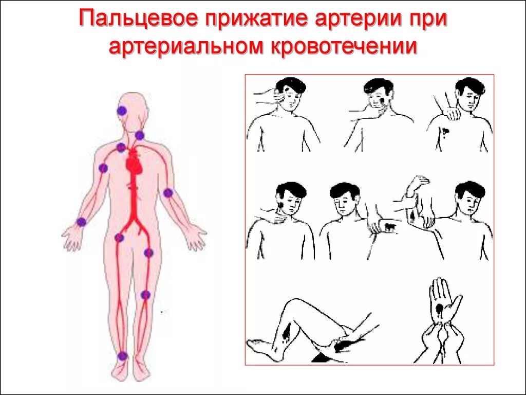 Способы остановки кровотечения пальцевое прижатие артерии. Пальцевое прижатие артерий при артериальном кровотечении. Метод остановки кровотечения пальцевое прижатие. Остановка артериального кровотечения пальцевым прижатием. Места остановки кровотечения пальцевым прижатием.