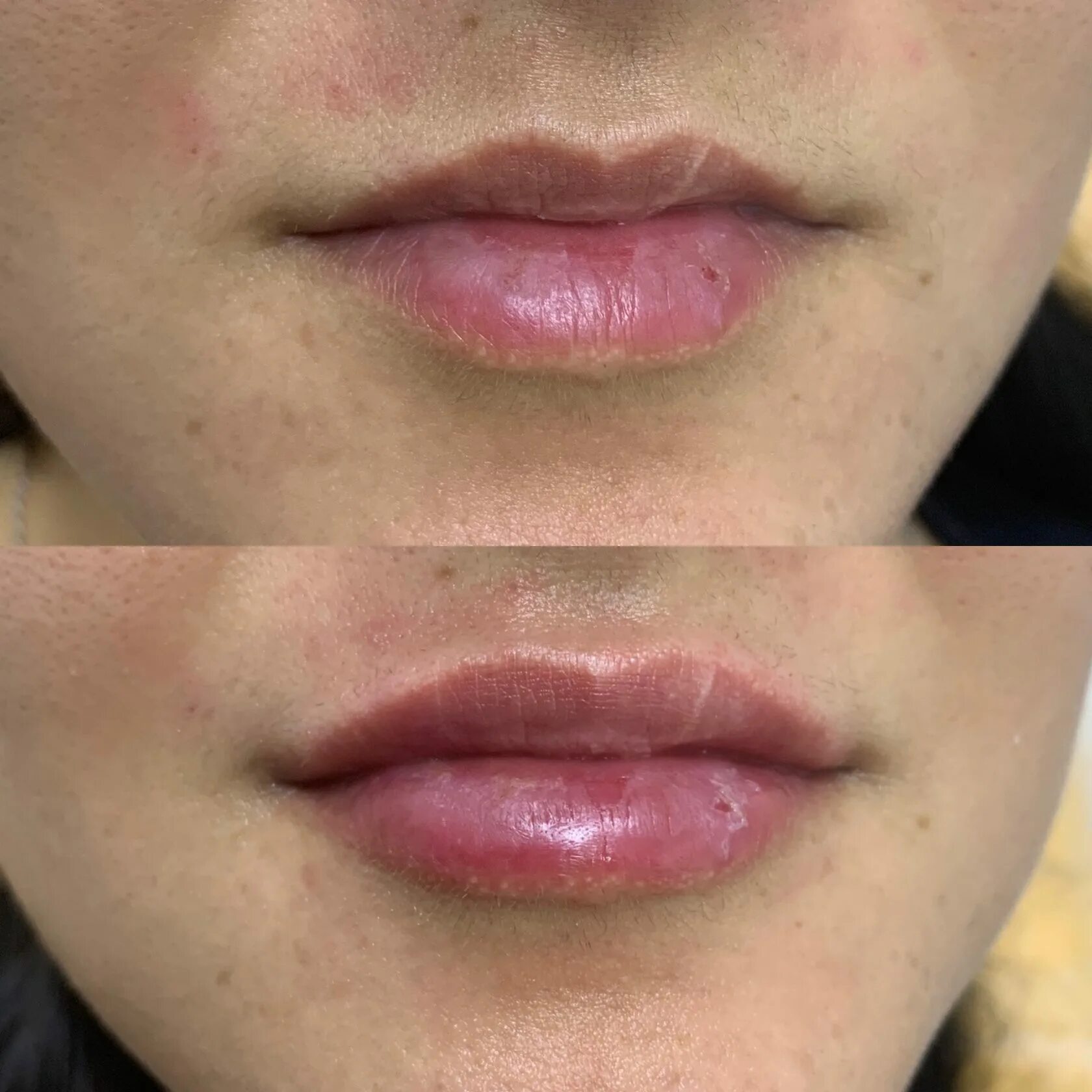 Техники увеличения губ с фото. Коррекция губ. Увлажнение губ гиалуроновой кислотой. Естественные губы гиалуроновой. Накачивание губ гиалуроновой кислотой.