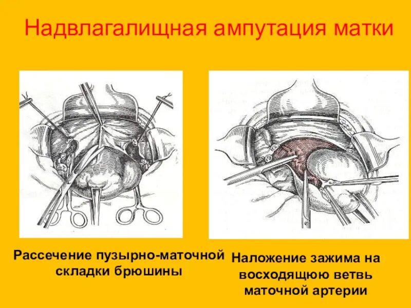 Надвлагалищная ампутация матки. Экстирпация матки и ампутация матки. Надвлагалищная ампутация матки этапы. Пузырно маточная складка.