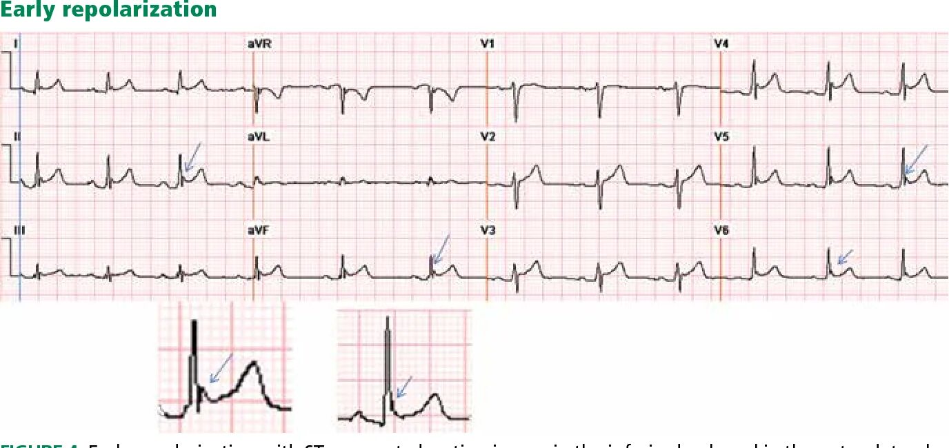 Подъем st v2. Ранняя реполяризация желудочков на ЭКГ. СРРЖ на ЭКГ. Синдром ранней реполяризации желудочков на ЭКГ. Реполяризация желудочков сердца на ЭКГ.