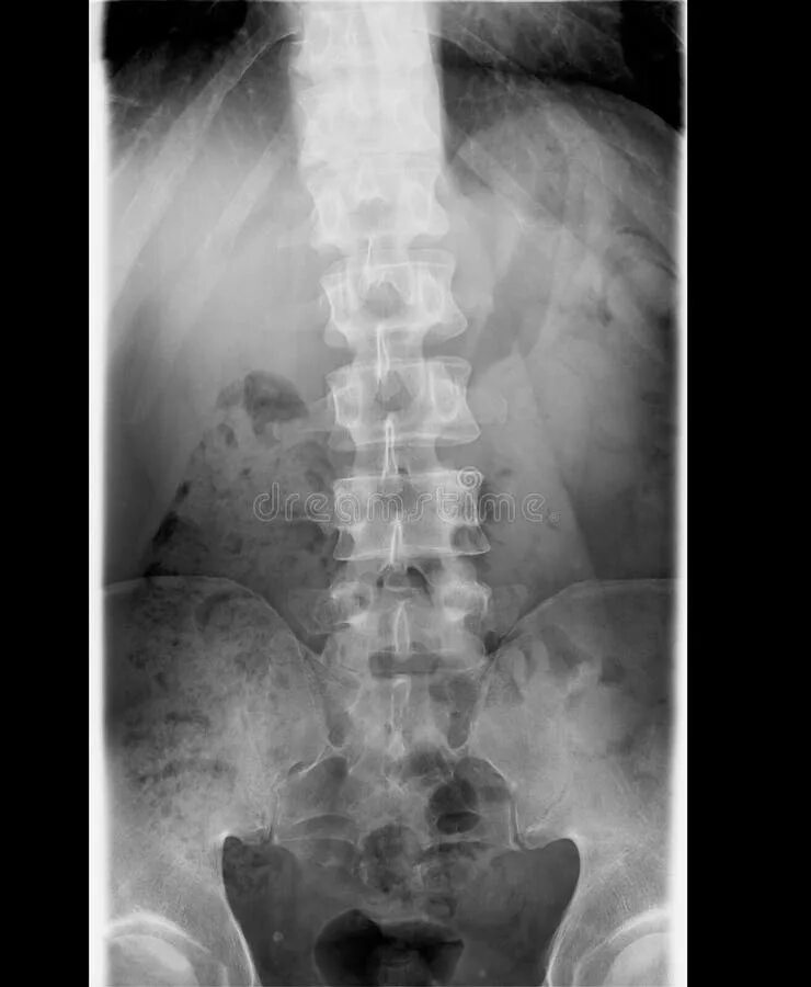 Rayos x lumbo-sacro columna vertebral y pelvis fotomural * fotomurales sacro, fé