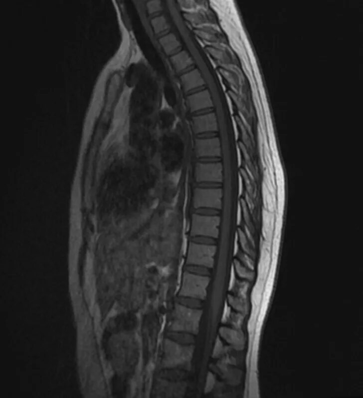 Мрт спинного отдела. Мрт грудного отдела позвоночника. Мрт грудного отдела позвоночника норма. Мрт позвоночника остеохондроз. Остеохондроз грудного отдела мрт.