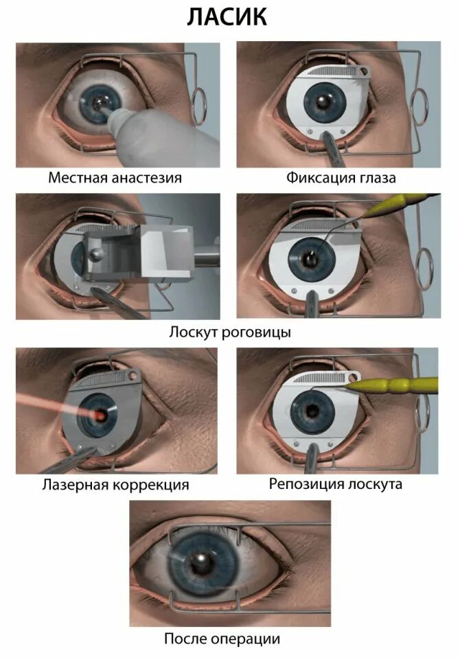 Коррекция зрения методом ласик. Лазерная коррекция зрения LASIK. Лазерная операция на глаза ласик. Лазерная коррекция зрения Femto LASIK. Отзывы после лазерной операции