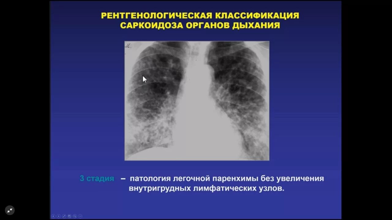 Легкие больного саркоидозом. Легкие больного саркоидозом. Саркоидоз рентген грудной клетки. Саркоидоз 1 стадия рентген. Легкие больного саркоидозом.